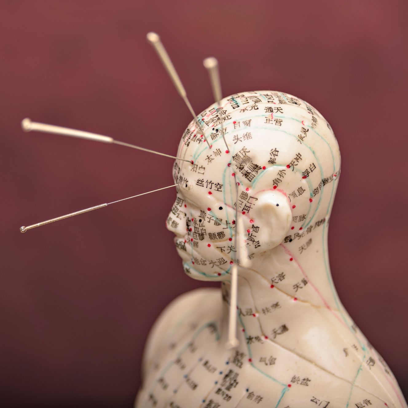 L’acupuncture